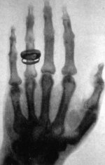 X-ray_by_Wilhelm_Röntgen_of_Albert_von_Kölliker's_hand_-_18960123-02.jpg